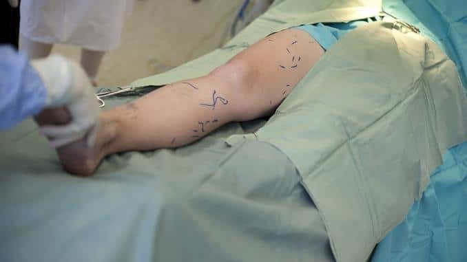 operation-varicose-veins