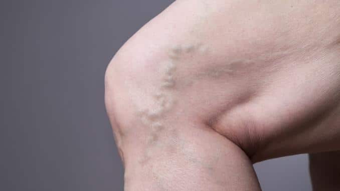 varicose-veins-closeup